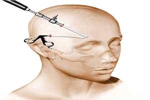 lifting frontal tunisie
