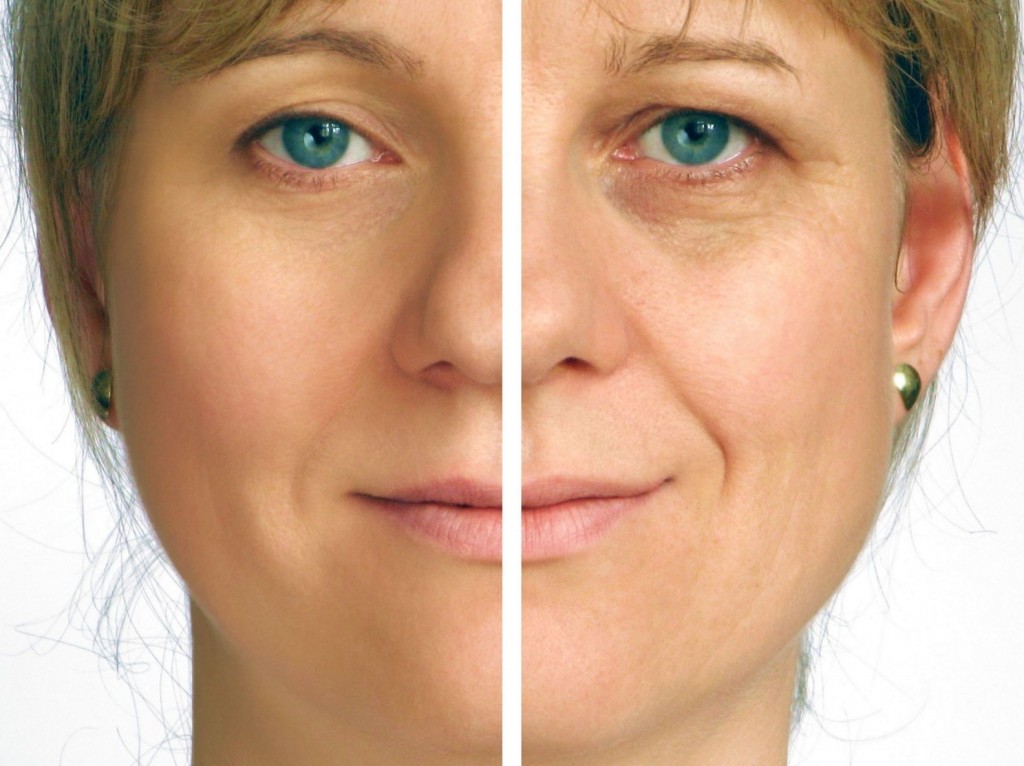 blepharoplastie Tunisie 