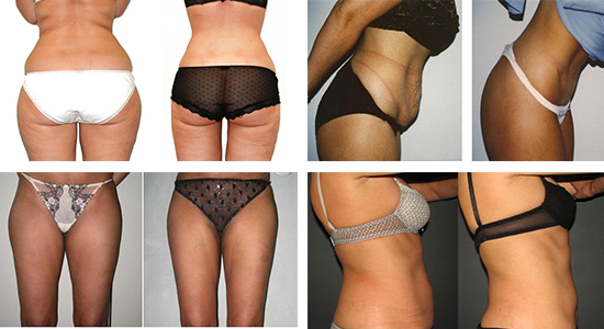 liposuccion avant apres