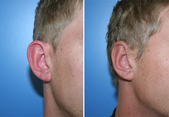 Otoplasties esthétiques (correction des oreilles)