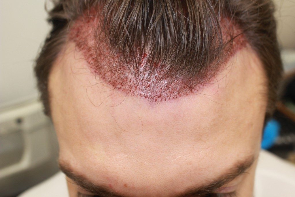 microgreffe cheveux