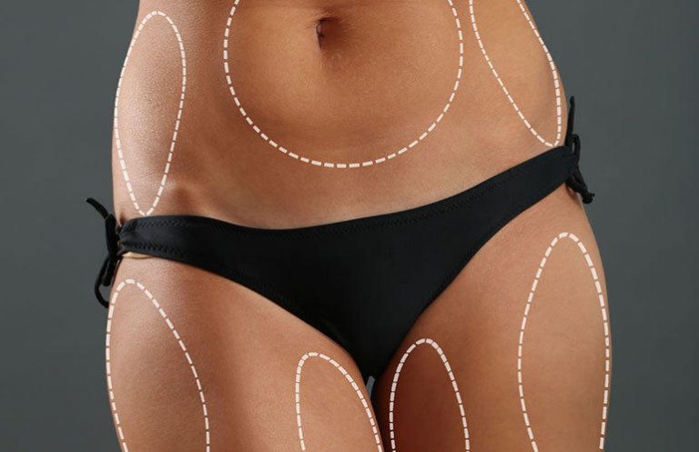 Le succès et les imperfections au niveau du résultat de la liposuccion