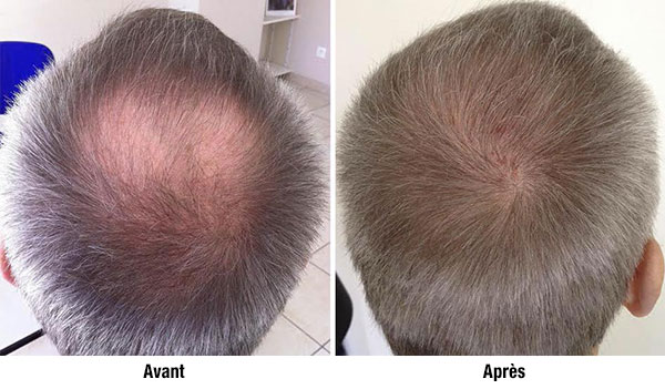 complications greffe cheveux