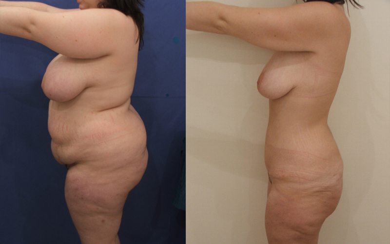 Plastie abdominale pour un ventre plat
