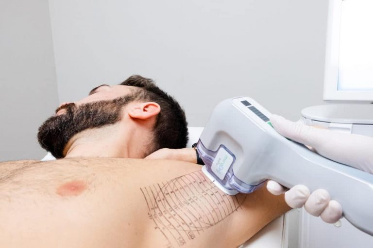 MiraDry : meilleur traitement de la transpiration excessive des aisselles