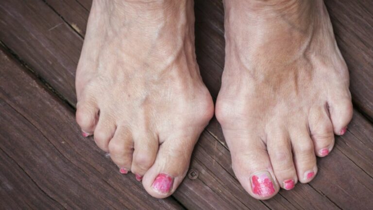 Hallux valgus : causes de sa déformation, symptômes et traitements  