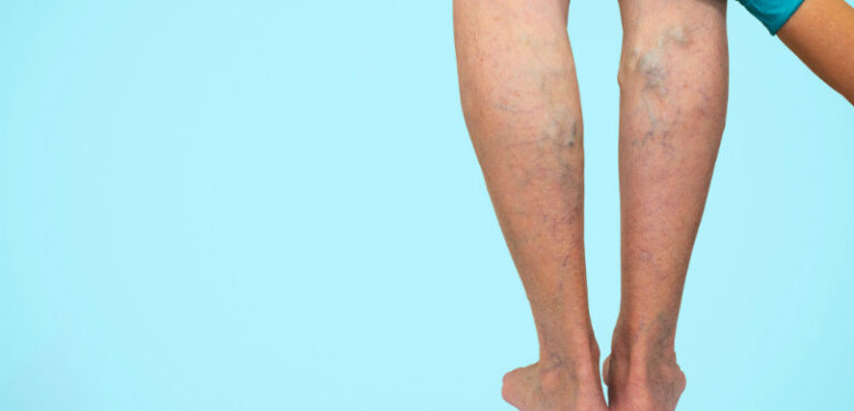 Toutes les infos sur les varices : causes, symptômes et traitements