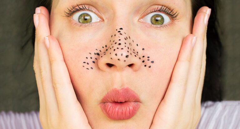 Comment enlever les points noirs ?